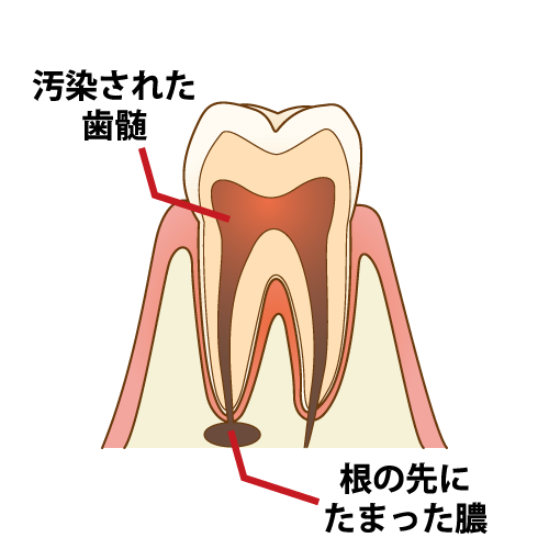 歯の根の先に膿が溜まっている状態