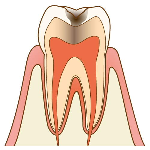 虫歯　C2