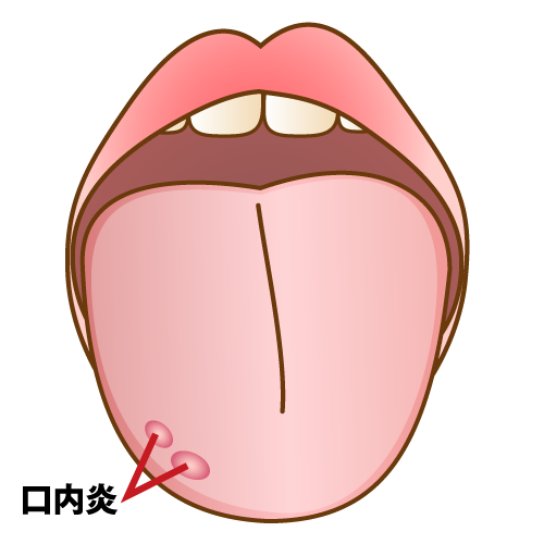 舌にできた口内炎の写真イメージ