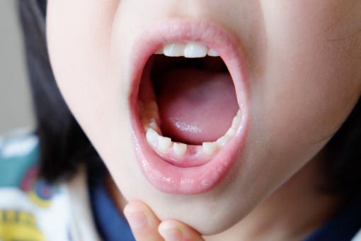 歯周病は子供へ感染する